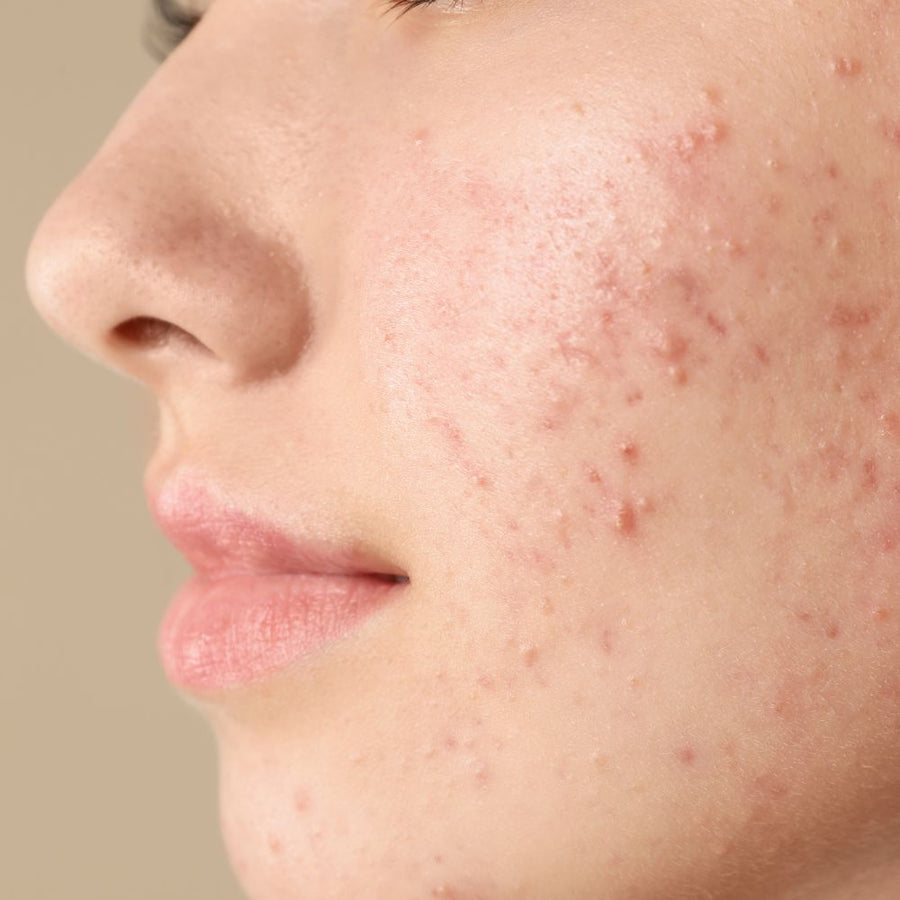 Acne-Prone Skin
