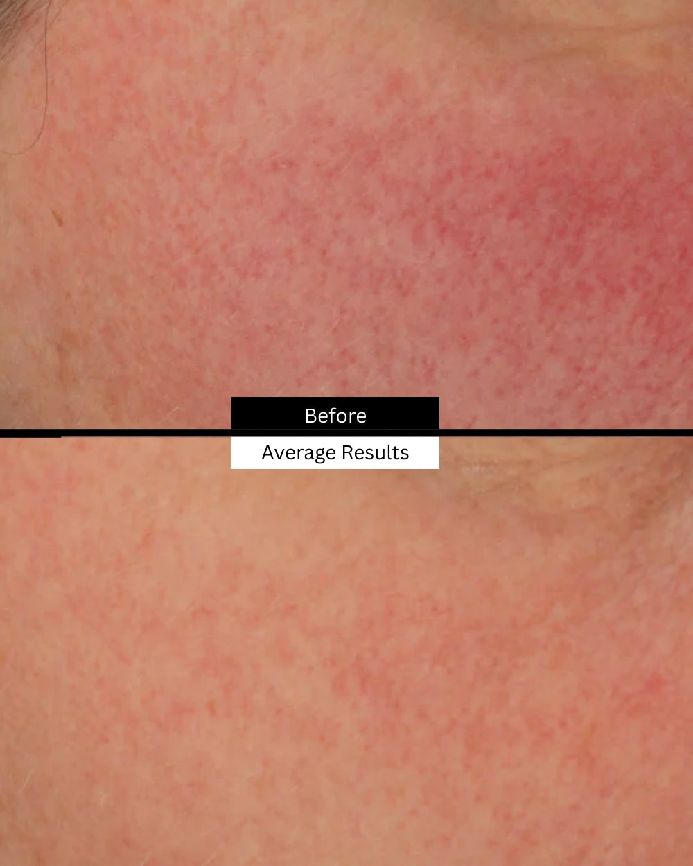 glycolic-10-renew-before-after